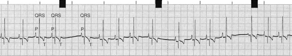 3 Φλεβοκομβικοί ρυθμοί Σχηματογράφημα 3.3 ΗΚΓ από σκύλο με αναπνευστική πνευμονογαστρική αρρυθμία με συχνότητα καρδιακών παλμών 110 παλμούς/min (25 mm/sec και 10 mm/mv). Σχηματογράφημα 3.4 ΗΚΓ από σκύλο φυλής Cavalier King Charles spaniel, 13 χρόνων, με καρδιακή ανεπάρκεια από ενδοκάρδωση της μιτροειδούς.