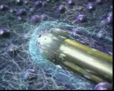 Εξάχνωση πηκτοειδούς πυρήνα (Percutaneous Nucleoplasty) H συσκευή