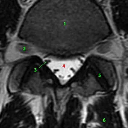 Ινώδης δακτύλιος (Annulus Fibrosus ).