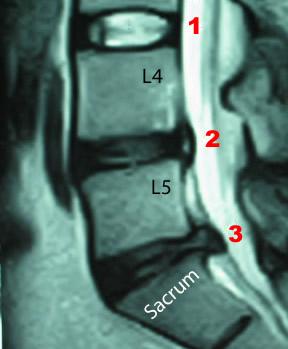 T2 Weighted MRI εικόνα. 1. Ο3-Ο4. Φυσιολογική απεικόνιση. 2. Ο4-Ο5.