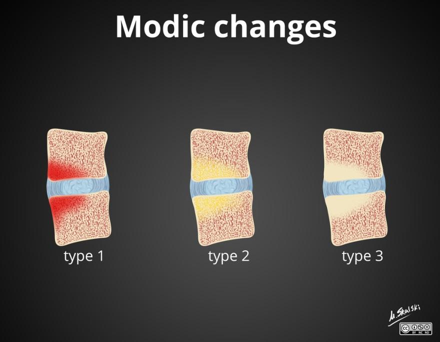 Αίτια του Πόνου Recently Modic type I has received renewed attention due to the possibility of it representing low grade infection.