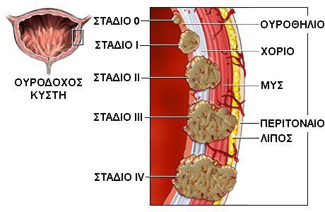 Εικόνα 16. Στάδια της νόσου Για ακριβή σταδιοποίηση του καρκίνου της ουροδόχου κύστης χρησιμοποιείται η ταξινόμηση TNM κατά WHO 2004 (IARC, 2004), (Εικόνα 17).