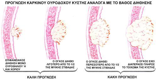 Εικόνα 18. Στάδια διήθησης και πρόγνωση 5. ΠΡΟΛΗΨΗ Όσον αφορά στην πρόληψη του όγκου της κύστεως, σήμερα ο μόνος γνωστός παράγοντας που ενοχοποιείται, είναι το κάπνισμα.