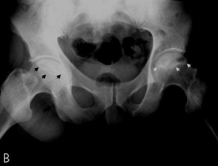 2 Σπινθηρογράφημα Το σπινθηρογράφημα (bone scan) με Τεχνήτιο 99 έχοντας υψηλή ευαισθησία χρησιμοποιείται στη διάγνωση των πρώιμων σταδίων της οστεονέκρωσης (Schoutens 1997).