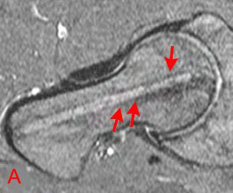 Εικ 7.1.2. Τρυπανισμοί (core decompression) μηριαίας κεφαλής με οστεονέκρωση. Στόχος είναι οι τρυπανισμοί να συμπεριλάβουν όλοι την έκταση της βλάβης.