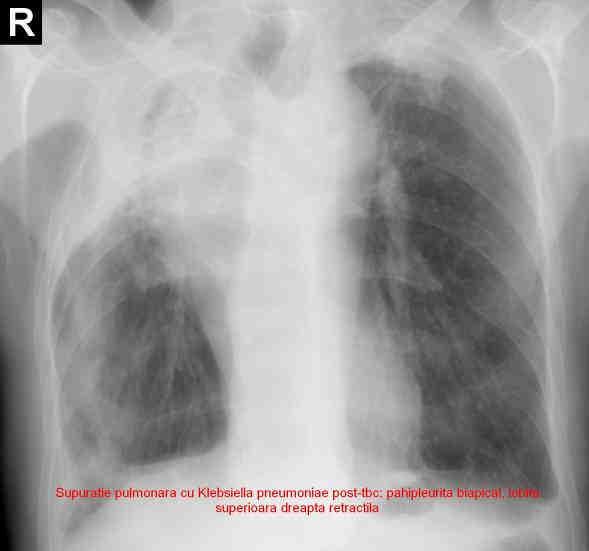 Cancerul bronho-pulmonar pe cicatrice de tuberculoză (Figura 25). Inflamaţia asociată cu infecţia bacteriană este un factor carcinogenetic major.
