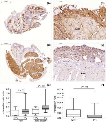 Airway pathology in severe