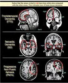 Progressive Nonfluent Aphasia - PA,)Progressive Nonfluent Aphasia) PA הקרויה גם,)Primary Progressive Aphasia) PPA היא הפרעה בתפקודי שפה המתאפיינת בקושי מתקדם בהפקת הדיבור.