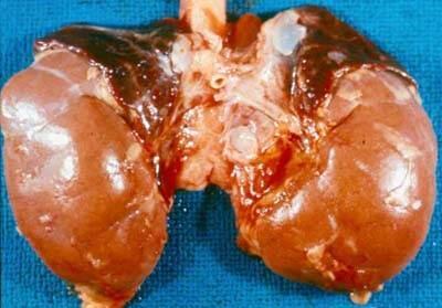 HIPOTONIA OSMOTICĂ EXTRACELULARĂ A. Hiponatremia absolută - prin pierderi renale de Na - 1. Deficitul primar de mineralocorticoizi I.