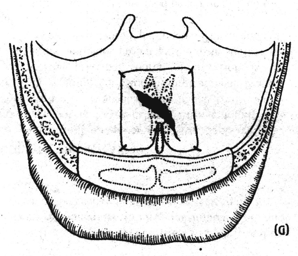 FISTULEI SI