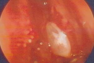 Permite accesul la leziuni situate mai posterior: sinus sfenoidal Tehnicile presupun identificarea fistulei si acoperire cu: grefe autologe,