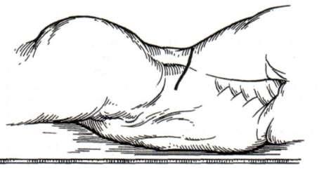 Fig.2 1.Incizie mediană(e. Ellison) 2.