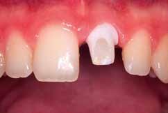Άσκηση 11η (ΕΡΓ) Τα δοκίμια του χρωματικού οδηγού αντιστοιχούν σε συγκεκριμένα κεραμικά υλικά που μιμούνται την οδοντίνη και την