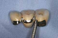 Άσκηση 21η (ΕΡΓ) Δεδομένου ότι οι τροποποιήσεις αυτές θα πρέπει να φέρουν την οπτική ποιότητα της προσθετικής εργασίας όσο πιο κοντά γίνεται στα φυσικά δόντια του ασθενή, καλό είναι να