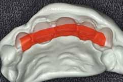 Χειρουργικός οδηγός Α) Διαγνωστικό κέρωμα Επί του εκμαγείου μελέτης το διαγνωστικό κέρωμα αποβλέπει στην κατ' εκτίμηση λειτουργική και αισθητική αποκατάσταση του οδοντικού ελλείμματος.