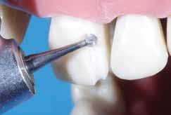 Η αυχενική εφαρμογή της αποκατάστασης εξασφαλίζει την περιφερειακή απόφραξη του οδοντικού τραύματος μέσω της εγγύτητας που επιτυγχάνεται μεταξύ των αυχενικών ορίων της και εκείνων της παρασκευής.