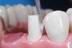 δημιουργείται και ο απαραίτητος χώρος που είναι ιδιαίτερα σημαντικός στις λειτουργικές υπερώιες επιφάνειες των άνω δοντιών (εικ. 7.