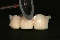 Γίνεται σταδιακή αφαίρεση όλης της μάζας του ακρυλικού ακροριζικότερα της ακμής που αντιστοιχεί στην άθικτη οδοντική ουσία και επομένως