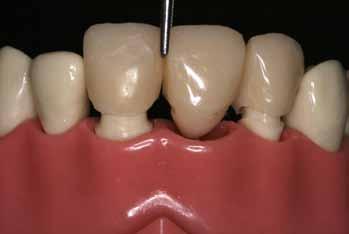2 Μεταβατική Φάση Προσθετικής Αποκατάστασης Η κυρτότητα των επιφανειών αυτών είναι απαραίτητη για να ευνοείται η απομάκρυνση της οδοντικής πλάκας.
