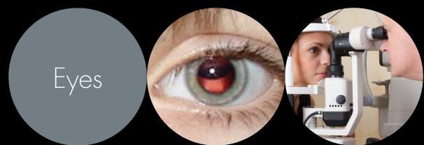 Klasiskā homocistinūrija CBS deficīts Klīniskās pazīmes acis Bieži Retāk Glaukoma Lēcas dislokācija Iridodenēze