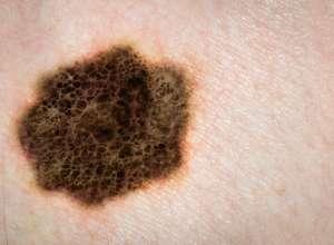 ΜΕΛΑΝΩΜΑ ΤΩΝ ΑΚΡΩΝ ΤΥΠΟΥ ΕΦΗΛΙΔΑΣ (ACRAL LENTIGINOUS MELANOMA, ALM) Αποτελεί τον πιο κοινό τύπο μελανώματος στη μαύρη (έως 70%) και την κίτρινη (45%) φυλή ενώ είναι σπάνιο στη λευκή φυλή (5-10%).