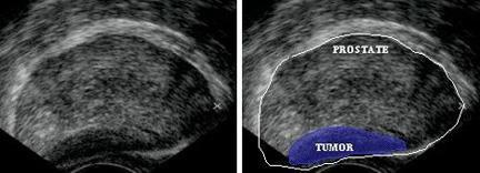 τρισδιάστατη προσέγγιση των ορίων του προστάτη αδένα και η σύμμορφη τεχνική