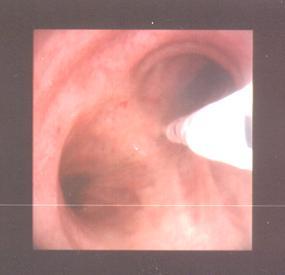 BRONCHOSCOPY Bronchoscopy (TBLB/ TBNA/ EBB/ BAL) EBB: