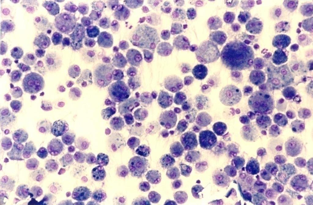 20% Sarcoidosis CD4 /CD8 < 2 12% EAA CD4
