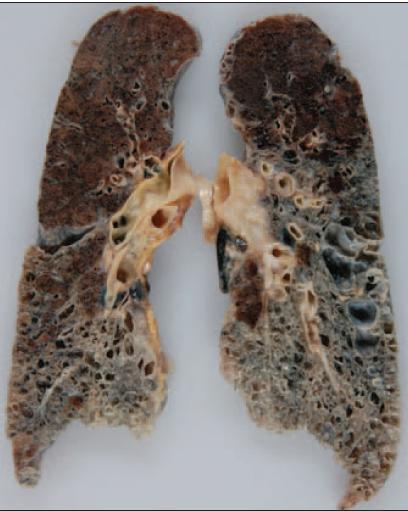 Idiopathic Pulmonary Fibrosis (IPF) Η ιδιοπαθής πνευμονική ίνωση (IPF) είναι μια μορφή χρόνιας, προοδευτικά εξελισσόμενης, ινωτικού τύπου διάμεσης πνευμονοπάθειας, άγνωστης αιτιολογίας, που