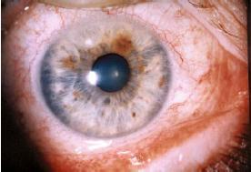 This necessitating routine slit-lamp and funduscopic examination Anterior uveitis Is the most common manifestation Chronic anterior uveitis, with