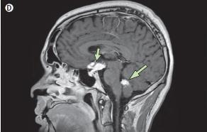 Neurologic Involvement CNS is involved in up to 25% of patients with sarcoidosis who undergo autopsy, but only 10% of all patients with sarcoidosis present with neurologic symptoms.