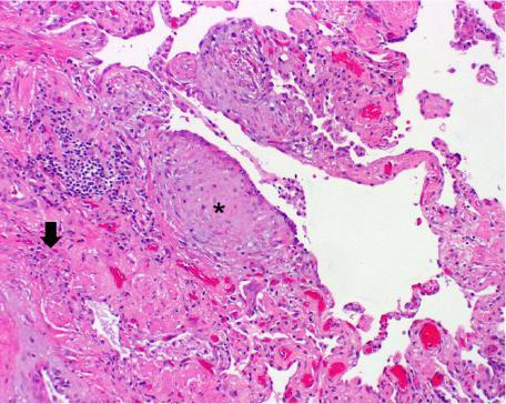 lung tissue Honeycomb spaces