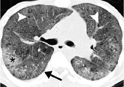 A surgical lung biopsy is required to