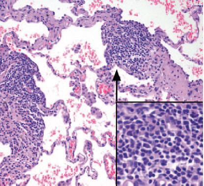 lymphoma, diffuse or nodular lymphoid