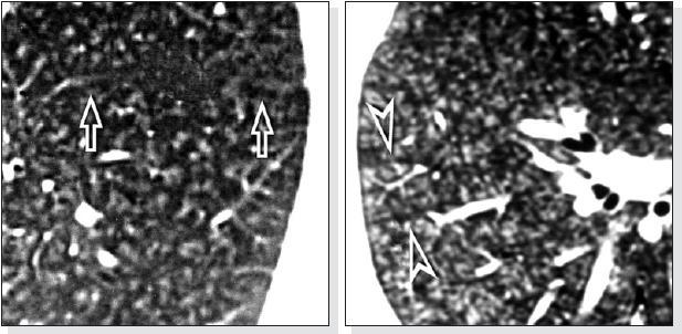 Nodular