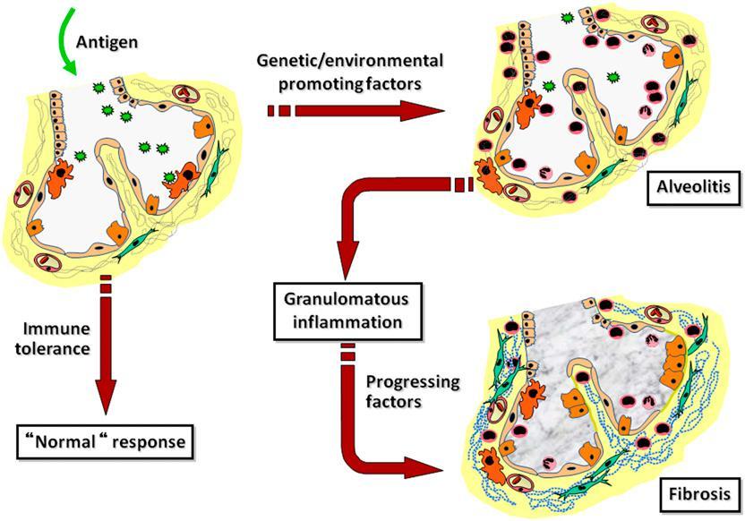 Hypersensitivity pneumonitis (ΗP)