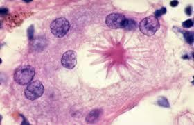 PATHOLOGOANATOMY-GRANULOMA The sarcoid granuloma usually consists of a compact (organized) collection of mononuclear