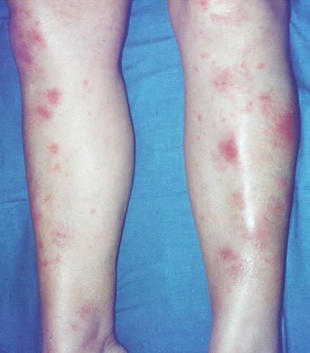 Löfgren's syndrome an acute presentation consisting of: Fever Arthralgia