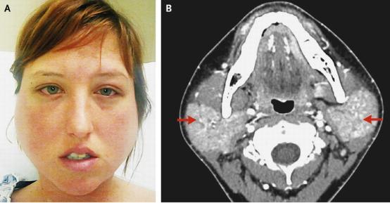 Anterior Uveitis Fever (often) Parotid