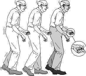 ) bradykinesia بطء الحركة). معالجة جراحية: المعالجة :Treatment إن ما نريده في علاج داء باركنسون هو إنقاص مخرج النوى القاعدية, واحدى الطرق المؤدية لذلك هي الطريقة الج ارحية.