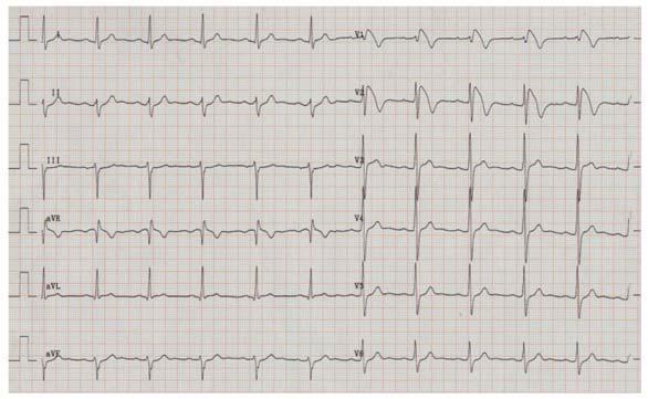 powerline noise Biological: EEG interfered by ECG Signal analytical: roundoff, quantization Signal