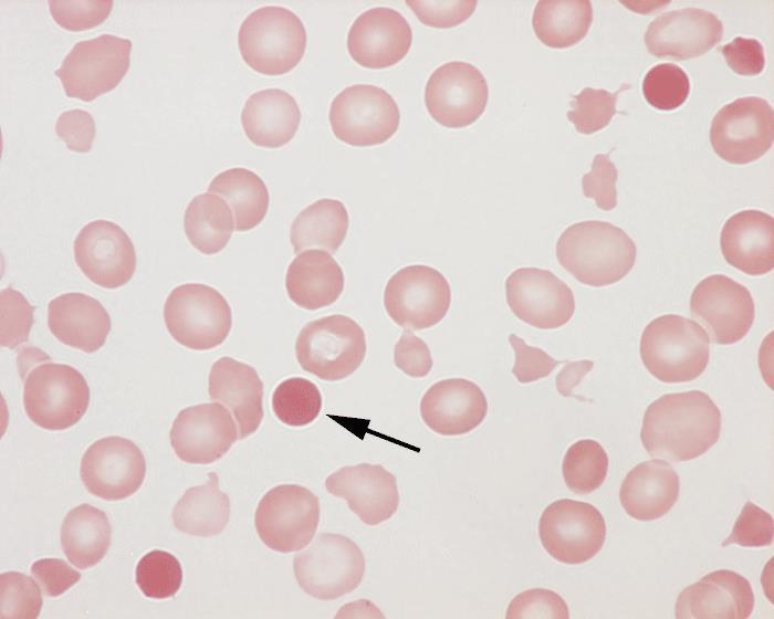 Prezenţa sferocitelor este caracteristică microsferocitozei ereditare şi anemiilor hemolitice,