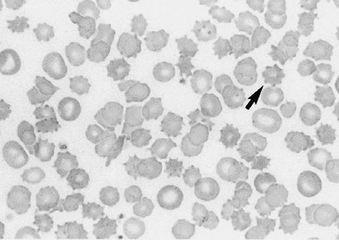 -extrinseci, legaţi de plasmă, în care eritrocitele îmbracă forme caracteristice de celulă