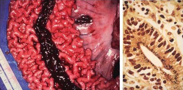 2. Enterita hemoragică - conţinutul intestinal are culoarea