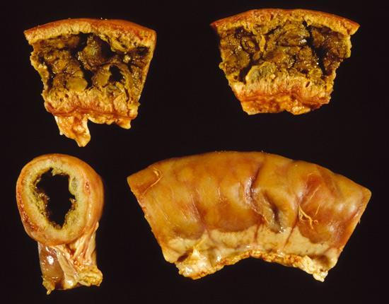 5. Enterita ulcero-necrotică Se poate constata o reacţie puternică la nivelul peretele intestinal şi la peritoneul visceral