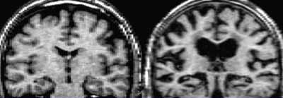MRI pri AB