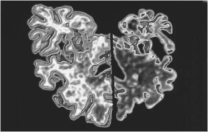 Alzheimer s