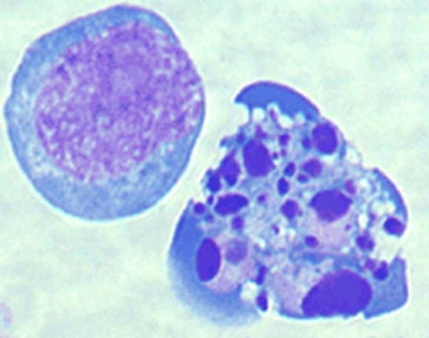 Apoptoza: mehanizem programirane celične smrti Koraki, ki vodijo v apoptozo: 1. Kondenzacija jedrnega kromatina. 2.