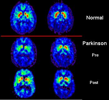 Diagnoza PB -V zgodnjih fazah razvoja PB je klinična diagnoza precej negotova.