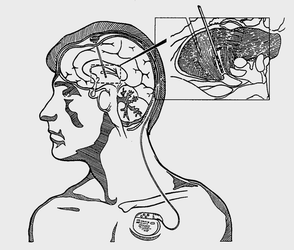 Kirurško zdravljenje Stereotaktična Lezije v možganih Spodbujanje (deep brain stimulation = DBS)